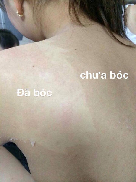 lột da