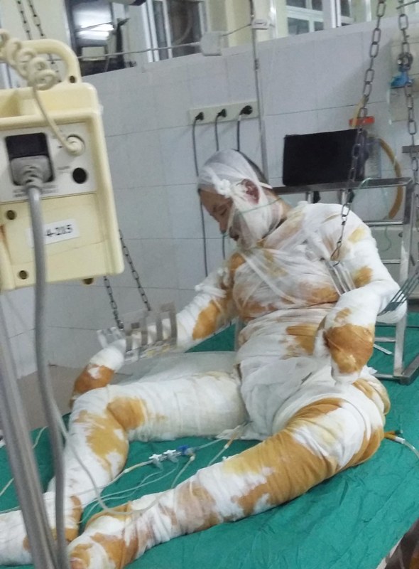 bỏng