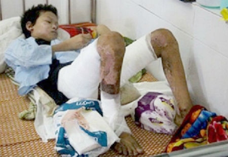 Bé Thành đang được điều trị tại bệnh viện 