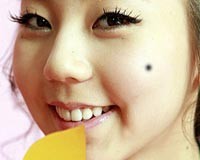 tẩy nốt ruồi