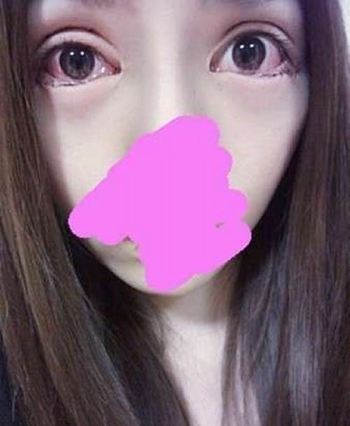 hậu dao kéo