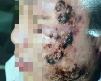 mặt nổi mụn 