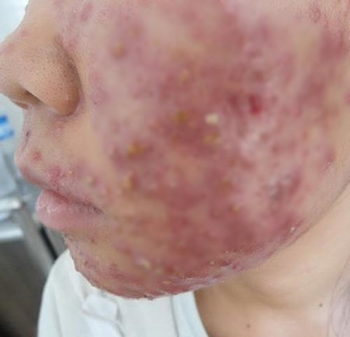 mặt nát vì collagen