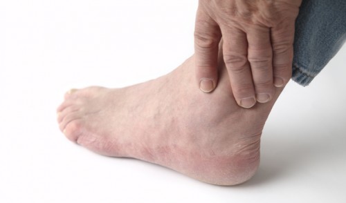 dấu hiệu bệnh gout
