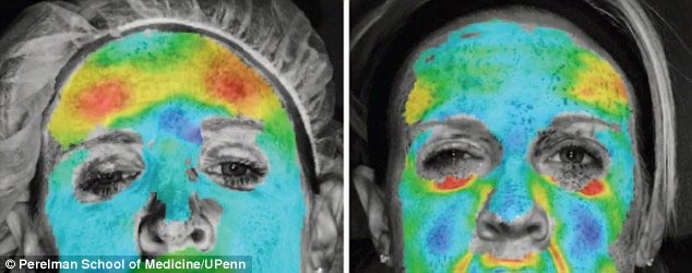 tiêm botox giảm nếp nhăn 