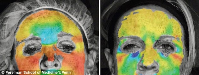 tiêm botox giảm nếp nhăn 