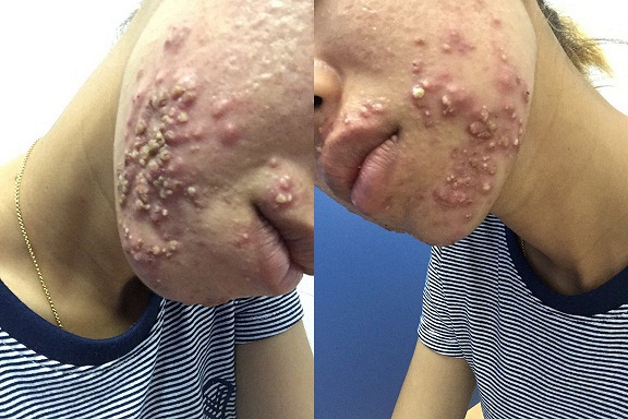 lở loét vì dùng kem qua mạng
