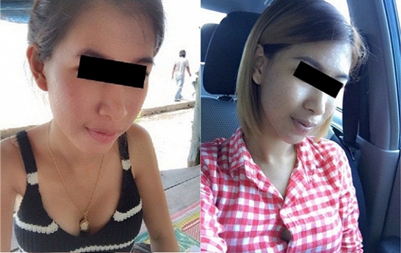 lở loét da vì dùng kem qua mạng 