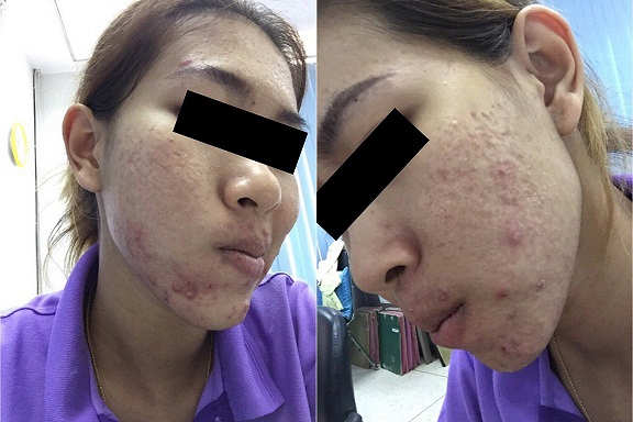 lở loét da vì dùng kem chống nắng