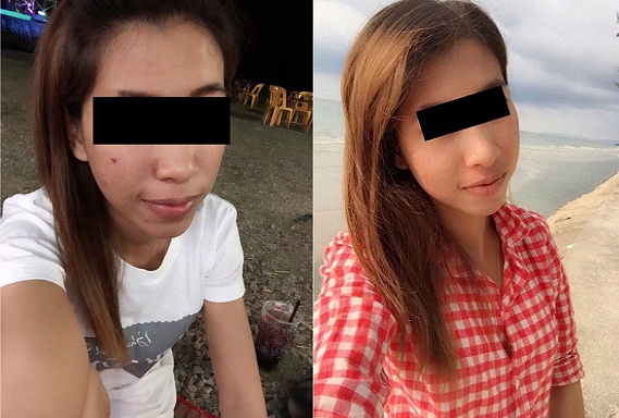 lở loét vì dúng kem qua mạng 