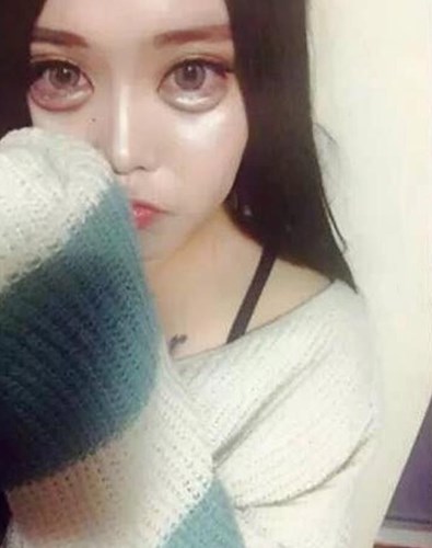 thẩm mỹ tạo bọng mắt 