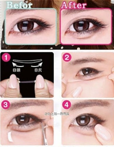 thẩm mỹ tạo bọng mắt 