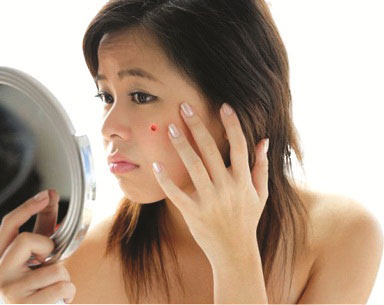 sạch mụn trứng cá