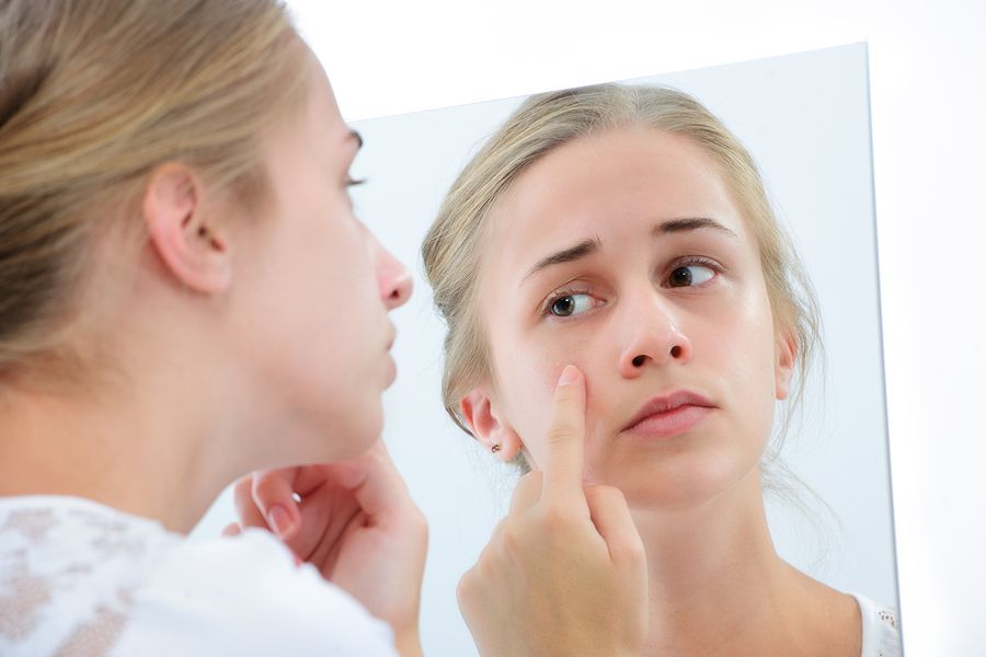 trị mụn trứng cá 