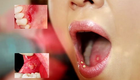 trị nhiệt miệng