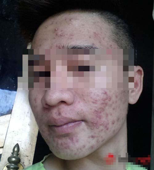 da bị mụn 