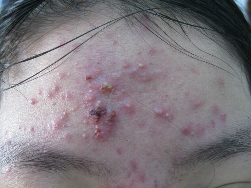 thuốc trị mụn trứng cá