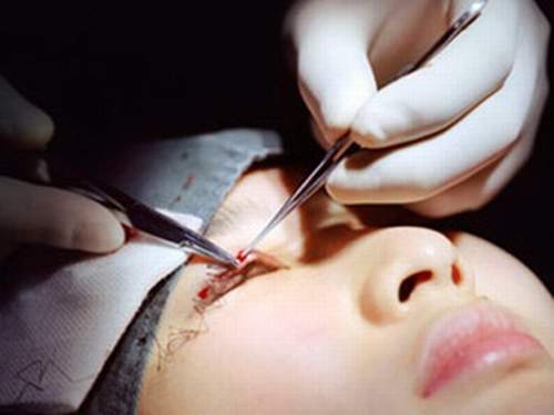 biến chứng do cắt mí