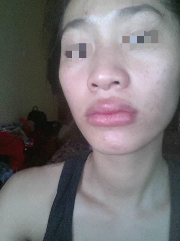hậu quả của thẩm mỹ