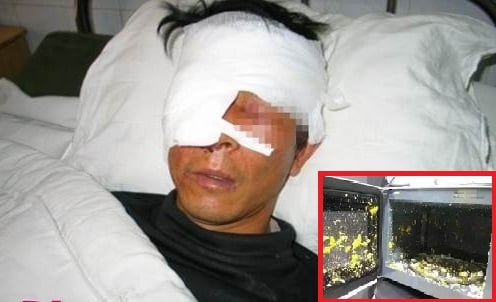 Người cha mù vĩnh viễn vì luộc trứng bằng lò vi sóng cho con 