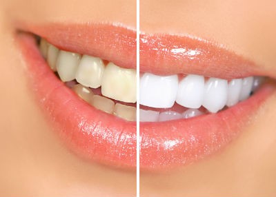 lấy coa răng tại nhà