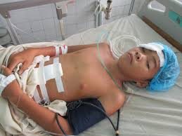 Cổ xe đạp gãy bất ngờ khiến nam sinh lớp 7 vỡ gan