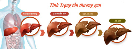 Rượu bia hại gan