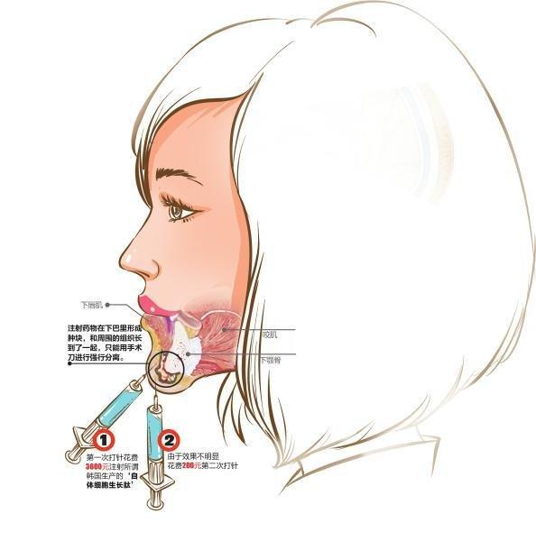 dao kéo