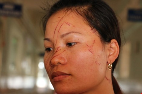 Hai mẹ con bị vợ chồng hàng xóm đánh đập, rạch mặt dã man