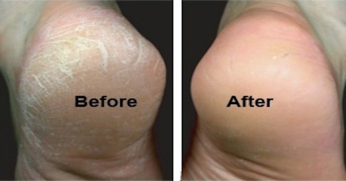 trị nứt gót chân