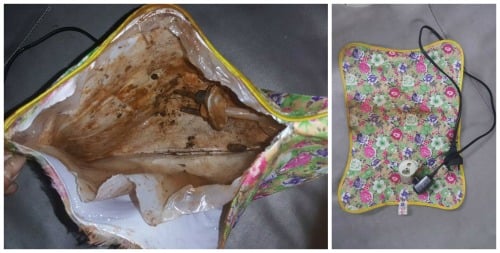 Nguy hiểm tính mạng khi sưởi ấm bằng túi chườm nóng