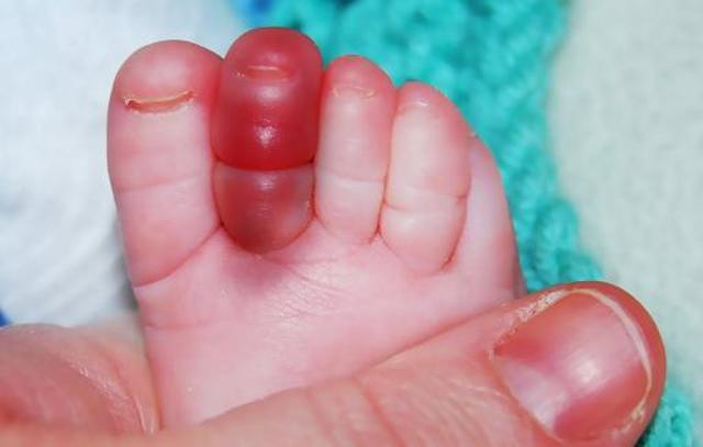 Trẻ có thể mất ngón chân, ngón tay chỉ từ một sợi tóc