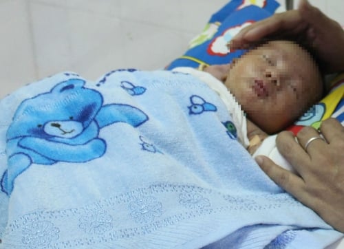 Bé 28 ngày tuổi bị dị tật ruột không có thần kinh