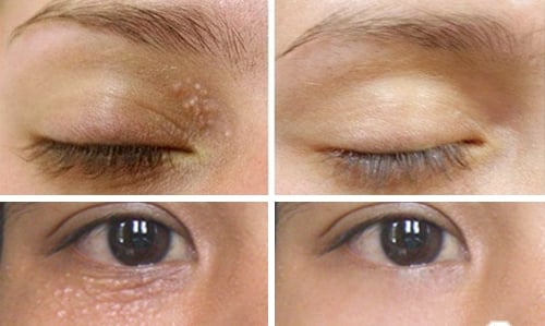 trị mụn thịt