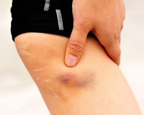 xóa bầm tím