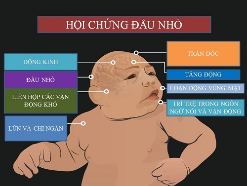 Những di chứng của virus Zika trên trẻ sơ sinh.