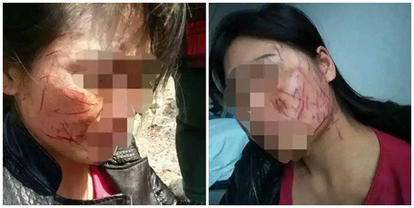 Người vợ bị chồng và bồ rạch hàng trăm nhát dao lên mặt