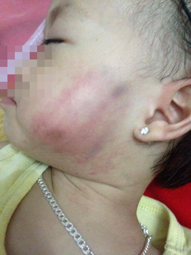Đình chỉ cơ sở mầm non có cô giáo tát bé gái bầm mặt để điều tra