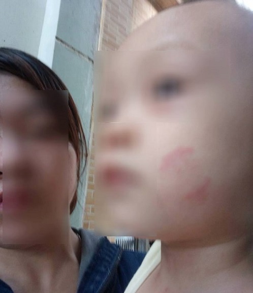 Bé trai bị cắn tím người, sứt tai khi ở trường mầm non về
