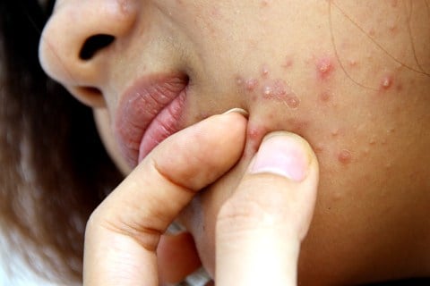 điều trị mụn trứng cá