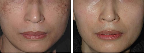 1 quả trứng gà xóa mờ tàn nhang, đẩy tone da lên sáng hồng