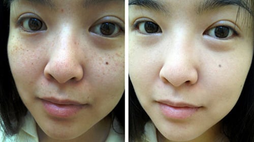 1 quả trứng gà xóa mờ tàn nhang, đẩy tone da lên sáng hồng 4