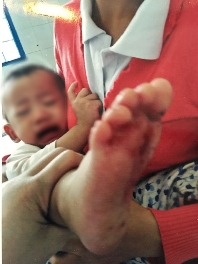 Vết bỏng đau rát khiến cháu bé quấy khóc liên tục.