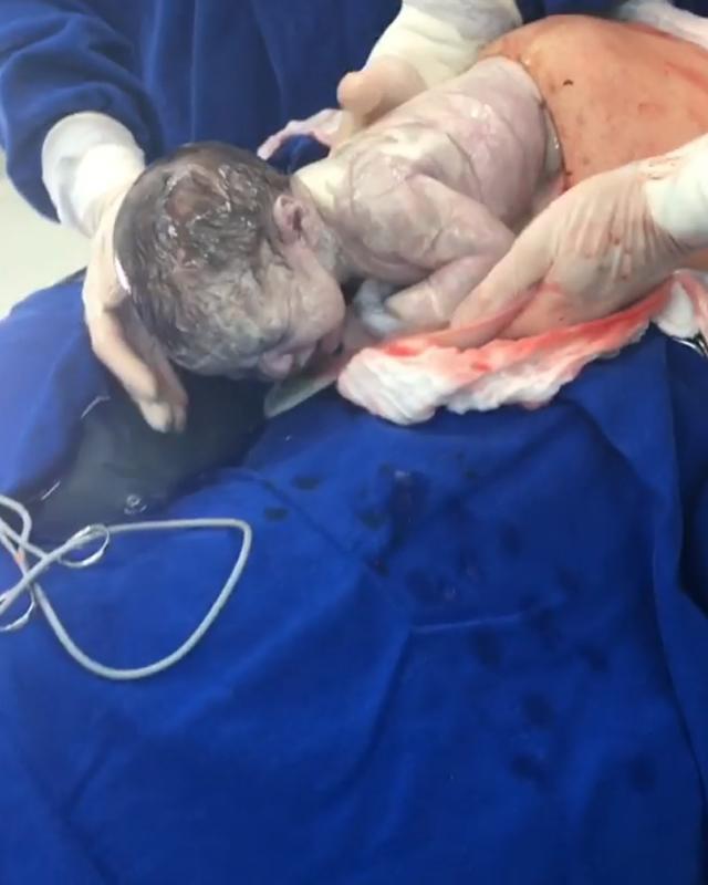 Sau đó khoảng 1 phút thì bọc ối đã tự vỡ ra.