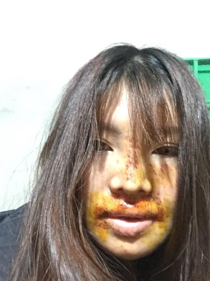 Gương mặt với vết thương chi chít được Phượng chia sẻ cách đây khoảng 2 tuần.