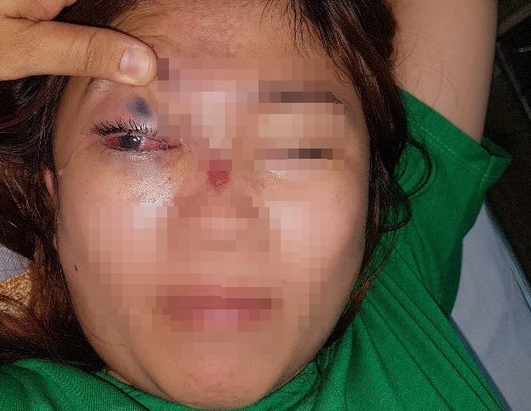 Mắt phải bệnh nhân mù hoàn toàn.