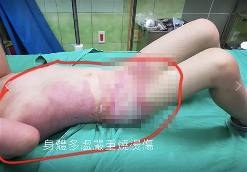Những vết bỏng khiến cô bé đau đớn và kêu khóc hàng ngày.