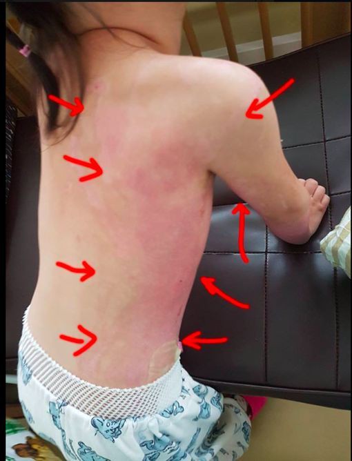 Khu vực đùi phải, cánh tay phải đều bị bỏng nghiêm trọng.
