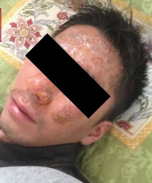 Khuôn mặt nạn nhân bị bỏng trầm trọng sau sự việc.
