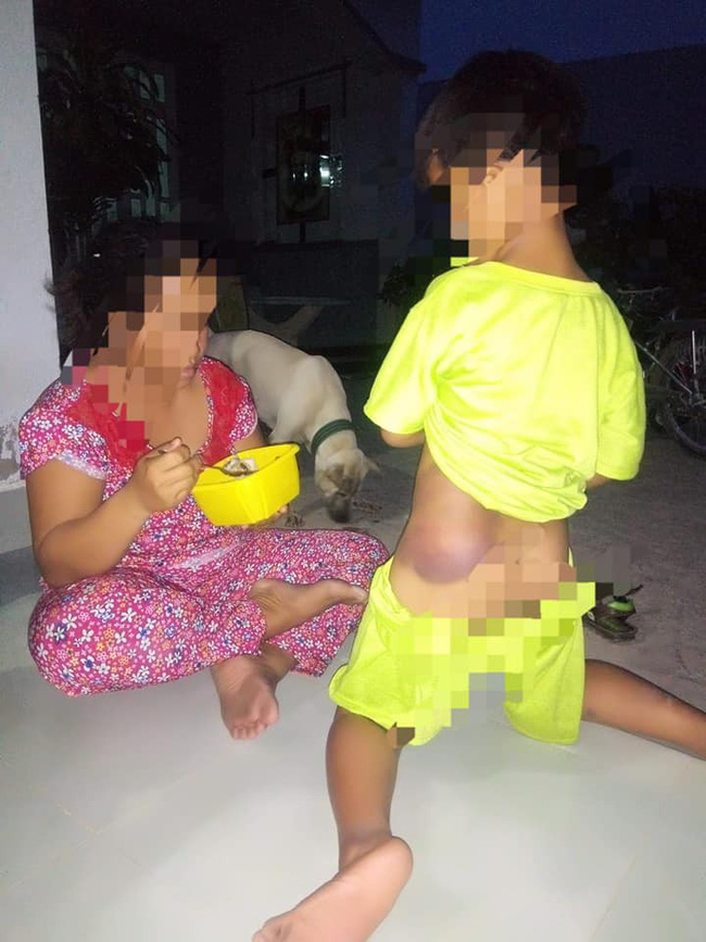 Bé K. rất sợ hãi sau khi bị cô giáo đánh, đi lại khó khăn.